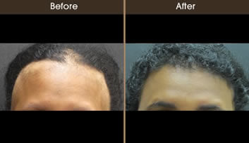 Hair Loss Treatment Before And After Front View
