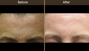 Sun Damage Treatment Before And After Front View