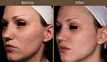 Skin Resurfacing Before And After
