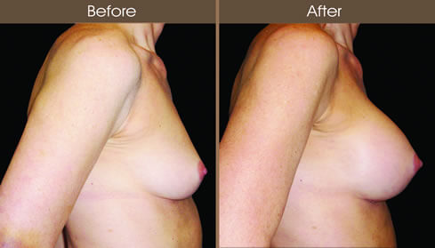 Breast Implant Results