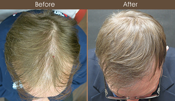 Hair Restoration In NYC Before And After