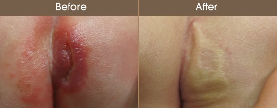 Before And After Vascular Lesion Treatment