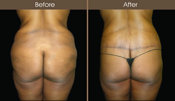 Body Lift Surgery Before And After