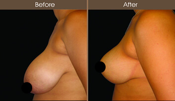 Breast Reduction Before And After Side View