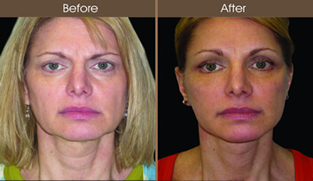 Cheek Lift Before And After