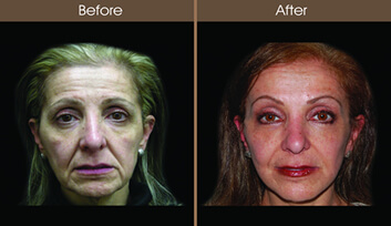 Facelift Before And After