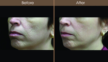 Skin Resurfacing Before And After Left Side View