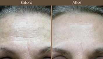 Laser Skin Resurfacing Results