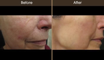 Rosacea Before And After