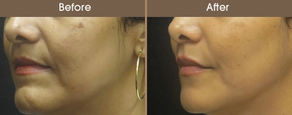 Juvederm Before And After