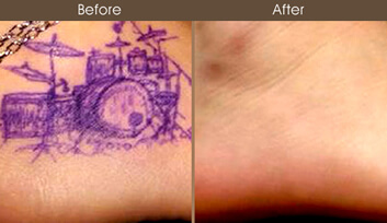Tattoo Removal NYC | Birthmark Removal & Melasma Manhattan