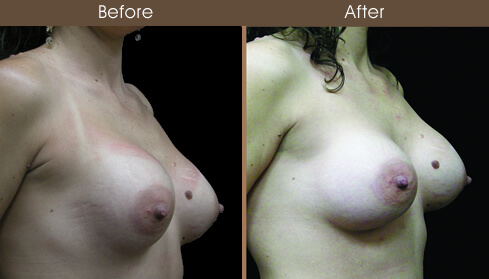 Breast Reconstruction Before And After Right Quarter Image