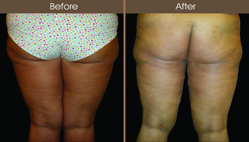 Thigh Lift Before And After Back View