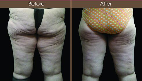 Thigh Lift Surgery Before And After Back Image