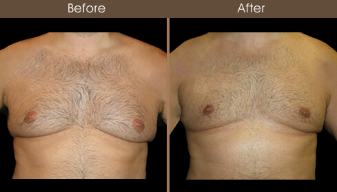 Breast Reduction For Men Before And After Front Image