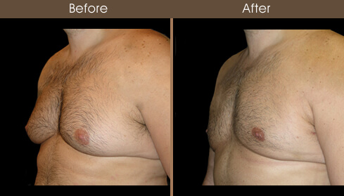 Breast Reduction For Men Before And After