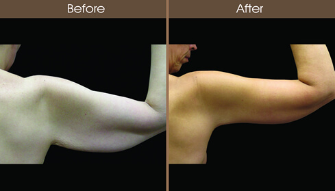Brachioplasty Before And After Back View