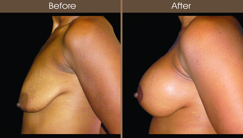 Mastopexy Before And After Left Side View