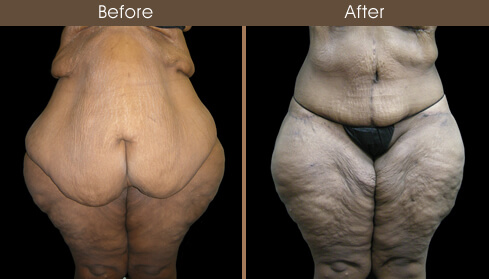 Post Bariatric Surgery Before And After Front View