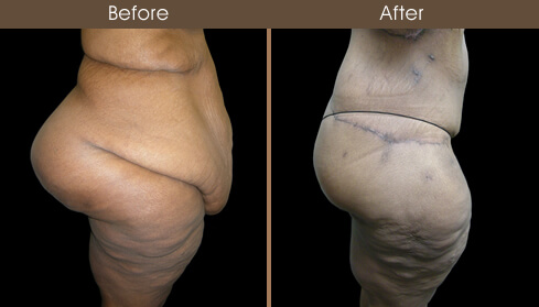 Post Bariatric Surgery Before And After Right Side View