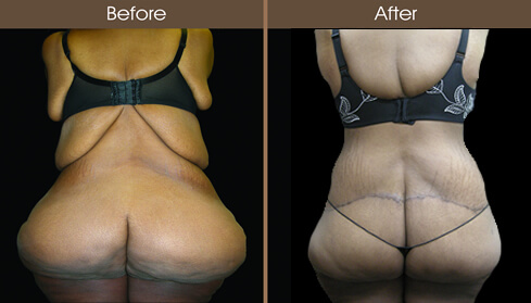 Post Bariatric Surgery Before And After Back View