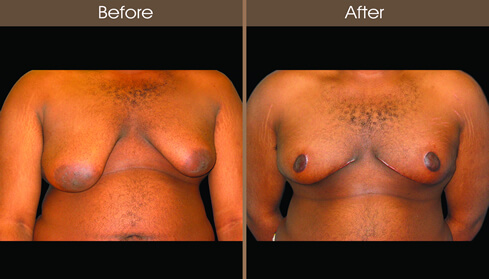 Male Breast Reduction Surgery Before And After Front View