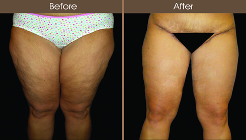 Thigh Lift Before And After Front View
