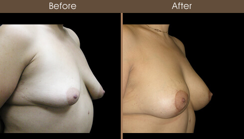 Post Bariatric Surgery Breast Augmentation Results