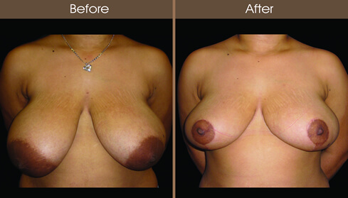 Breast Reduction Surgery Before And After Front View