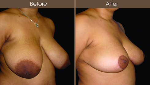 Breast Reduction Surgery Before And After Right Quarter View