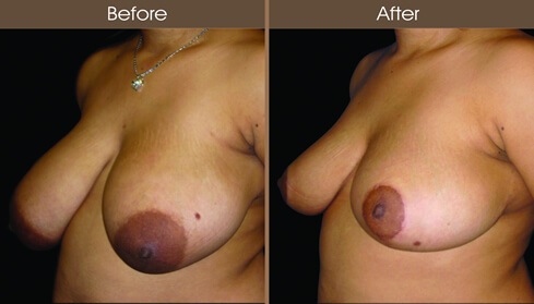 Breast Reduction Surgery Before And After Left Quarter View