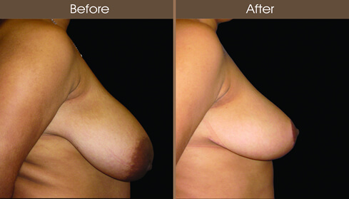 Breast Reduction Surgery Before And After Right Side View
