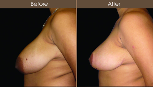Breast Reduction Surgery Before And After Left Side View
