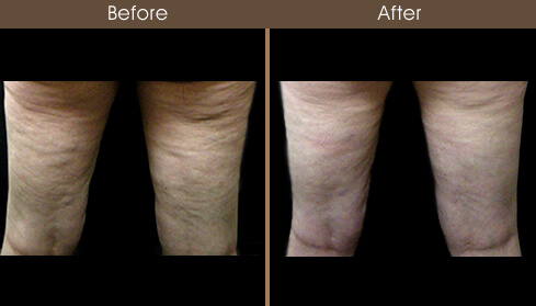 Before And After Cellulaze Treatment