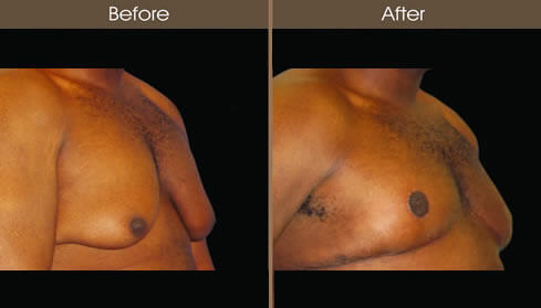 Male Breast Reduction Before And After Right Quarter Image
