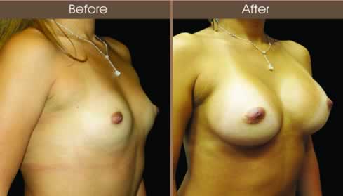 Breast Augmentation Surgery Before And After Right Quarter Image