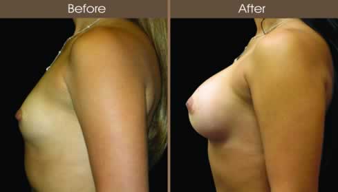 Breast Augmentation Surgery Before And After Left Side Image