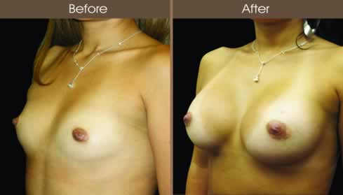Breast Augmentation Surgery Before And After Left Quarter Image