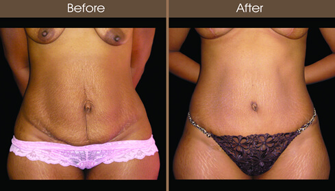 Tummy Tuck Before And After Front View