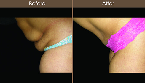 Abdominoplasty Before And After Left Side Image