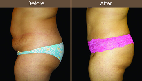 Abdominoplasty Before And After Left Side View