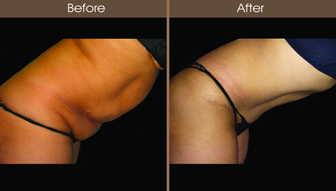 Tummy Tuck Surgery Before And After Right Side Image