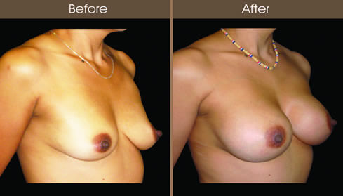 Breast Augmentation Before And After Right Quarter Image