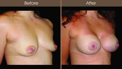 Breast Augmentation Before And After Right Quarter View