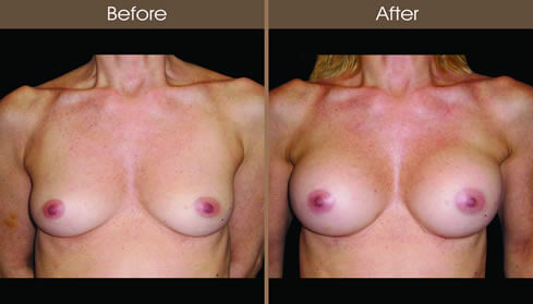 Breast Augmentation Surgery Before And After