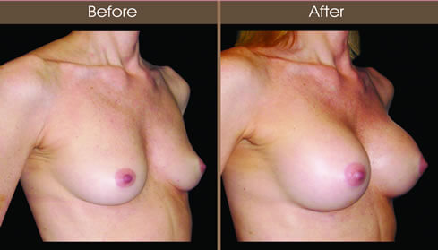 Breast Augmentation Surgery Results