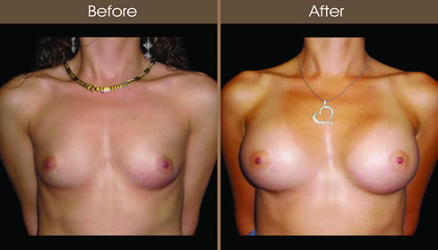 Breast Implant Before And After Front View