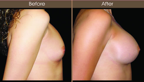 Breast Implant Before And After Right Side View