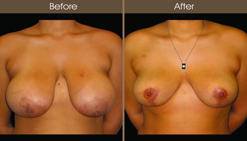Breast Reduction Before And After Front View