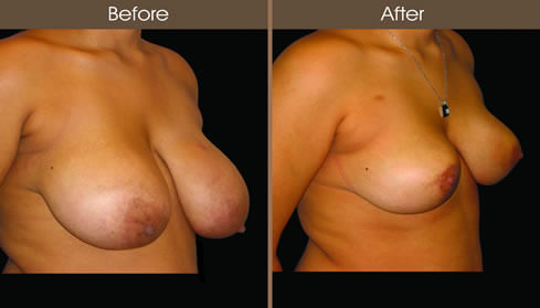 Breast Reduction Before And After Right Quarter View